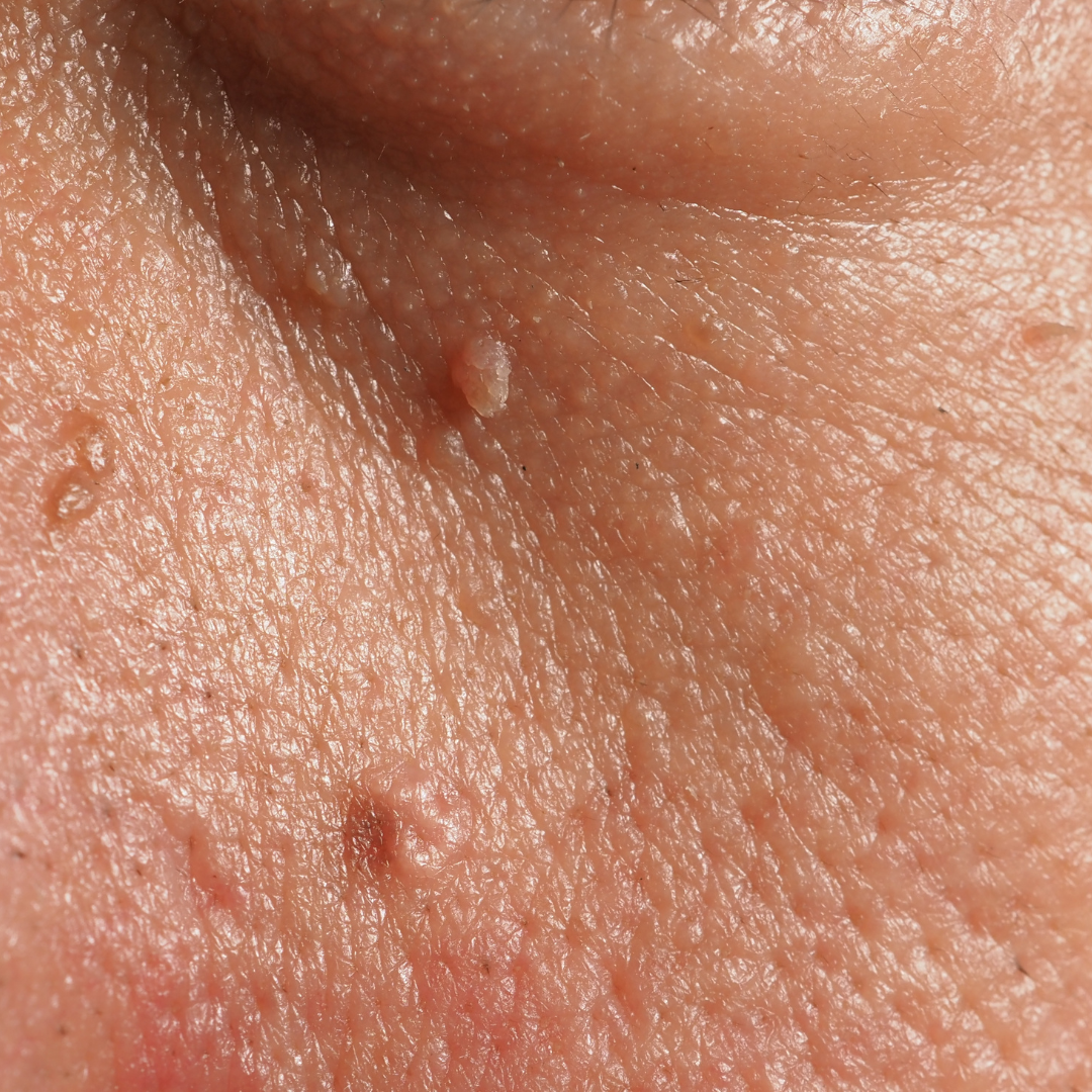 WART WARTS