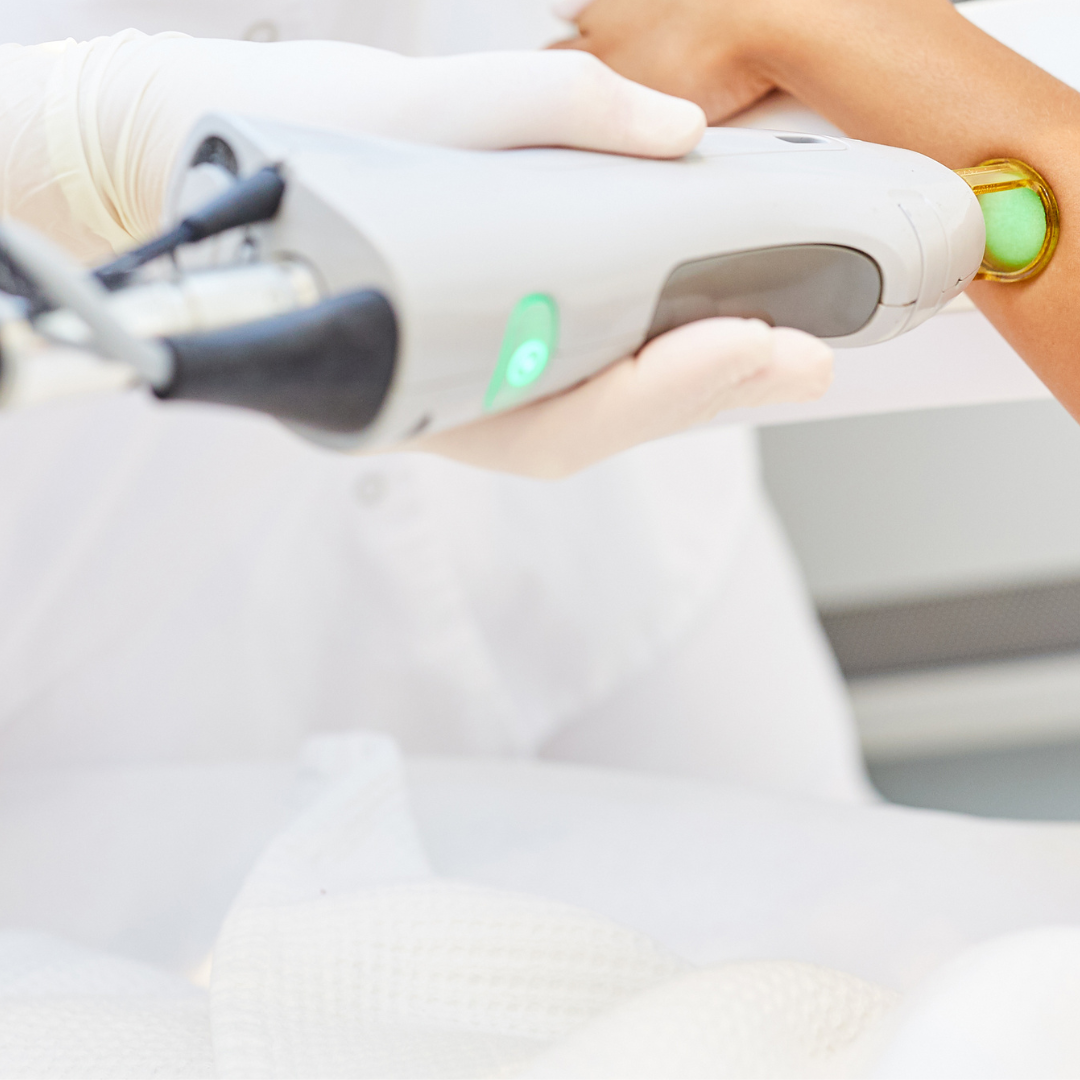 LASER MEMBERSHIPS ACNE