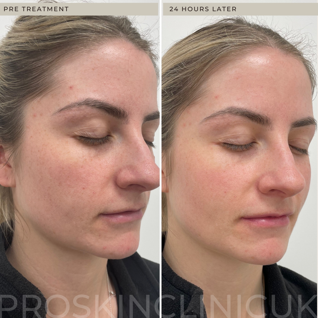 DEEP NEEDLE INFUSION acne