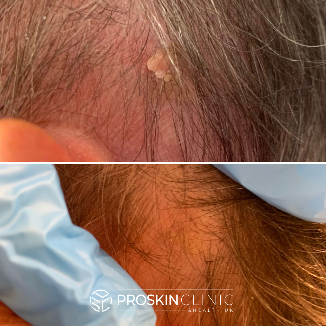 Skin Tag Removal Skin Tag Removal