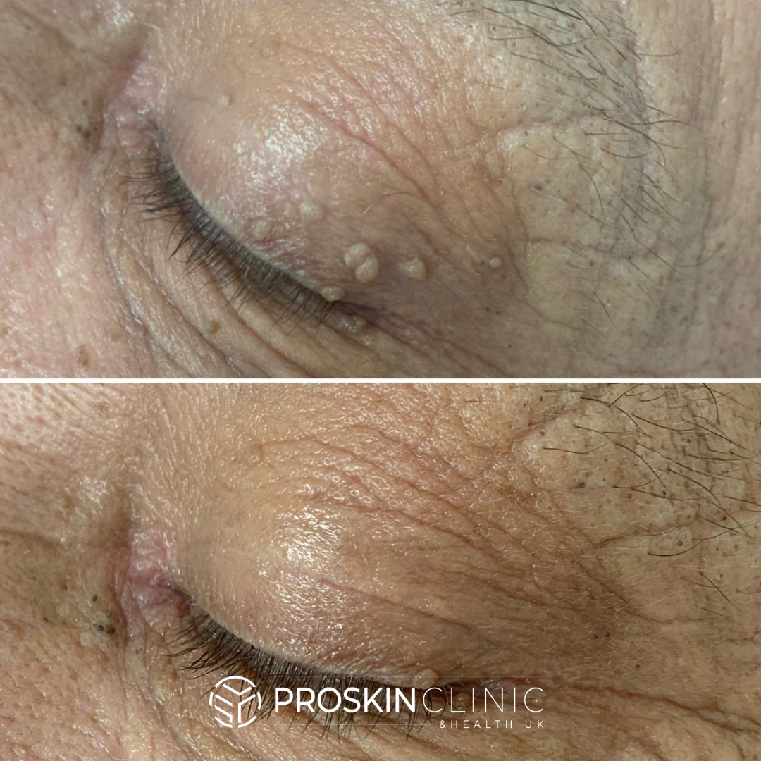 Skin Tag Removal Skin Tag Removal