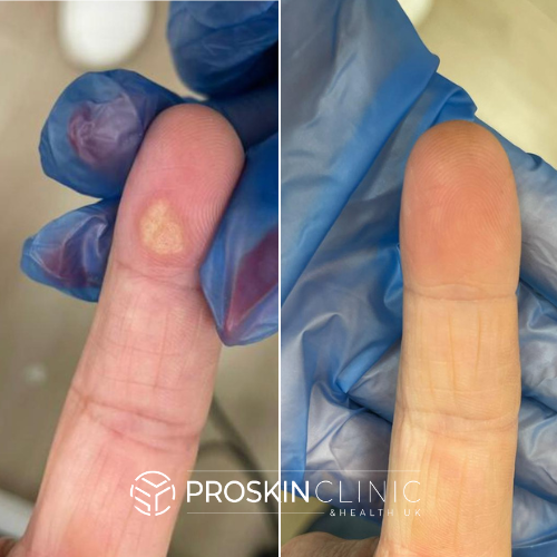 wart removal wart removal Gloucester