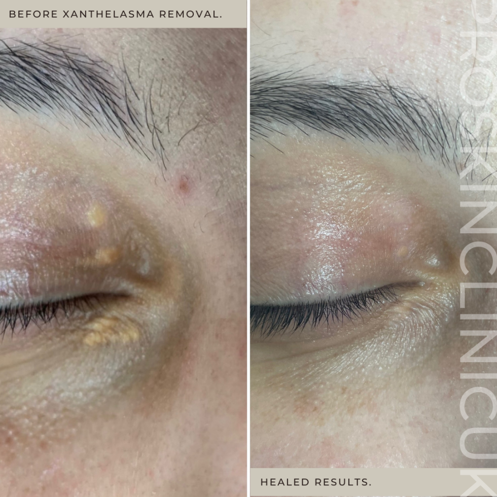 Xanthelasma Removal ProSkin Clinic & Health UK Gloucester