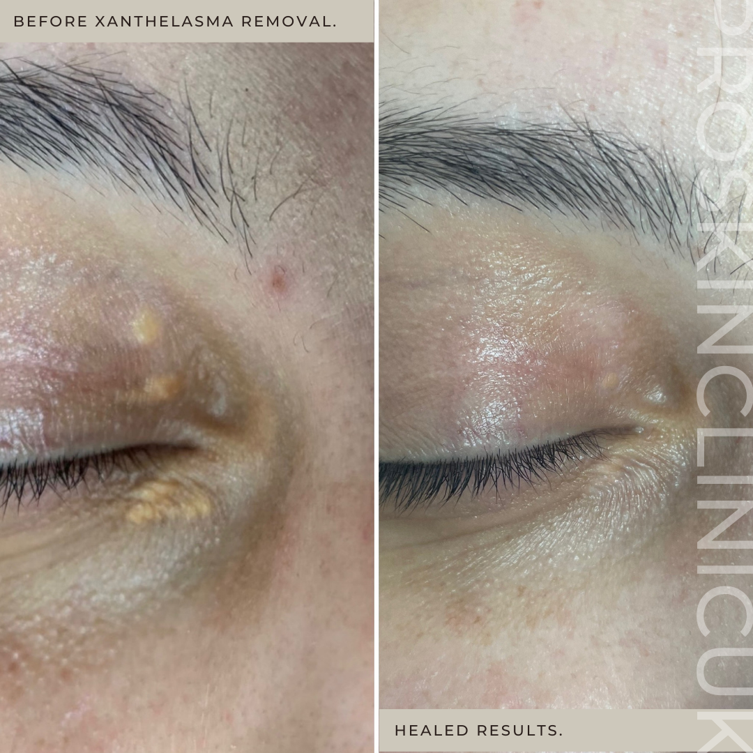 Xanthelasma Removal Xanthelasma Removal