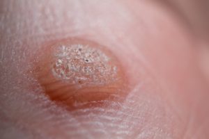warts