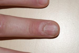 warts