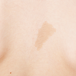 Birthmark Removal