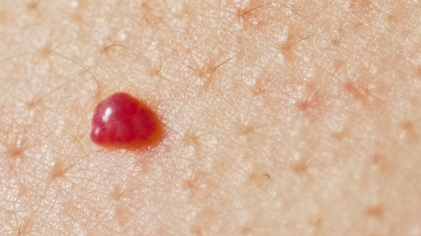 Blood Spot Removal Blood Spot Removal