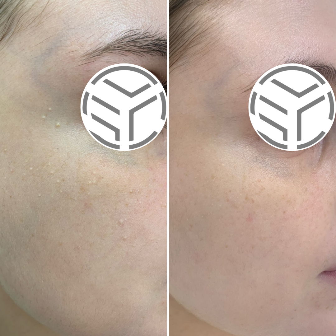 Milia Removal Milia Removal