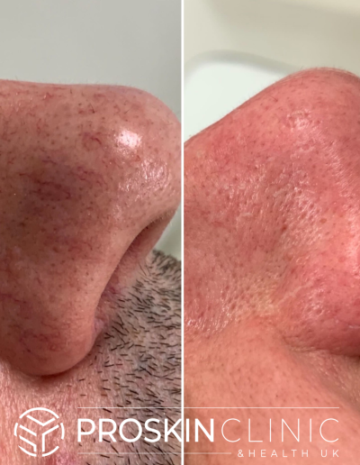 Thread Vein Removal