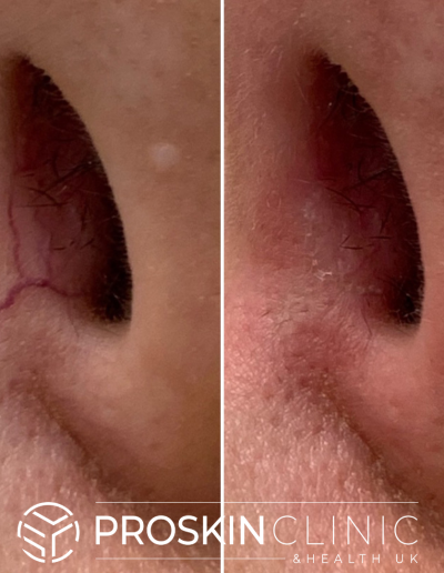 Thread Vein Removal