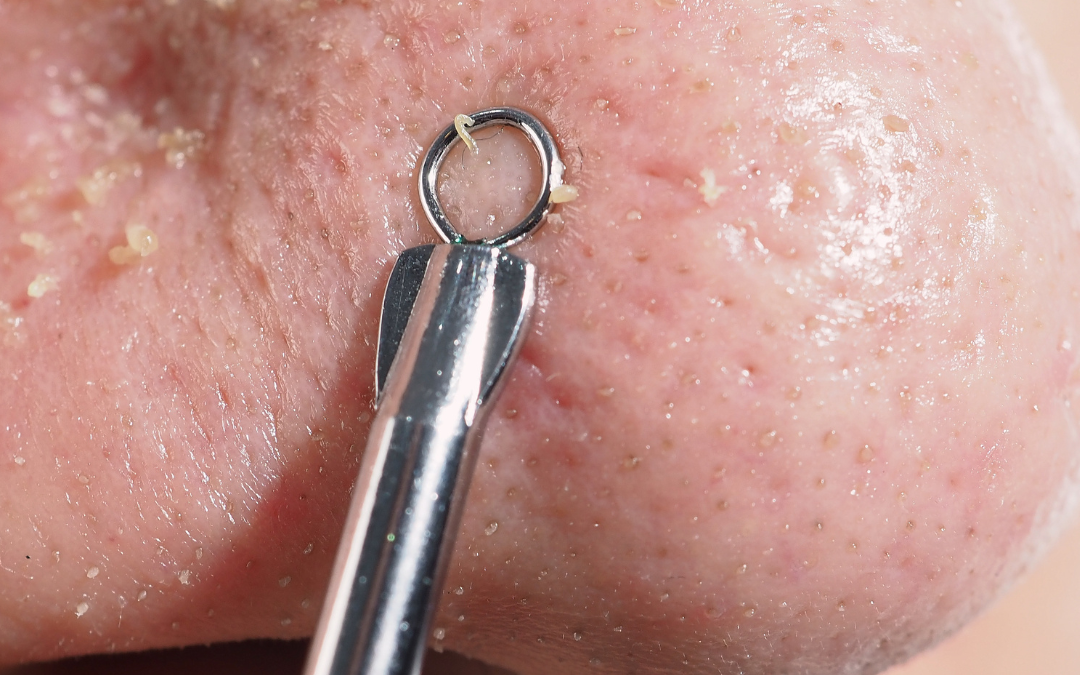 Blackhead Busting: Top 5 Myths & 5 Expert Tips for a Clearer Complexion
