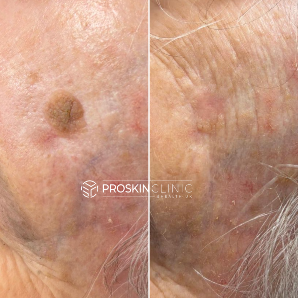 Seborrheic Keratosis Removal Gloucester ProSkin Clinic Health