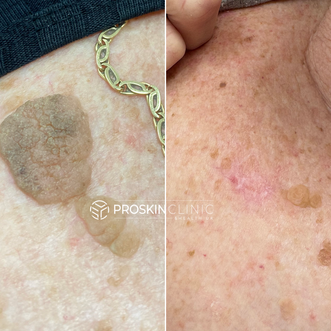 Seborrheic Keratosis Treatments Info Elm Lodge Beauty Studio